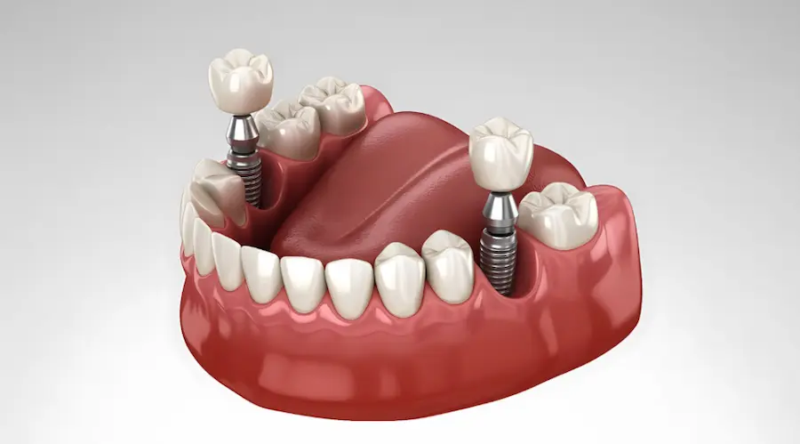 Modelo ilustrativo de implante dentário com pinos de titânio fixados no osso e coroas protéticas sobre a gengiva.