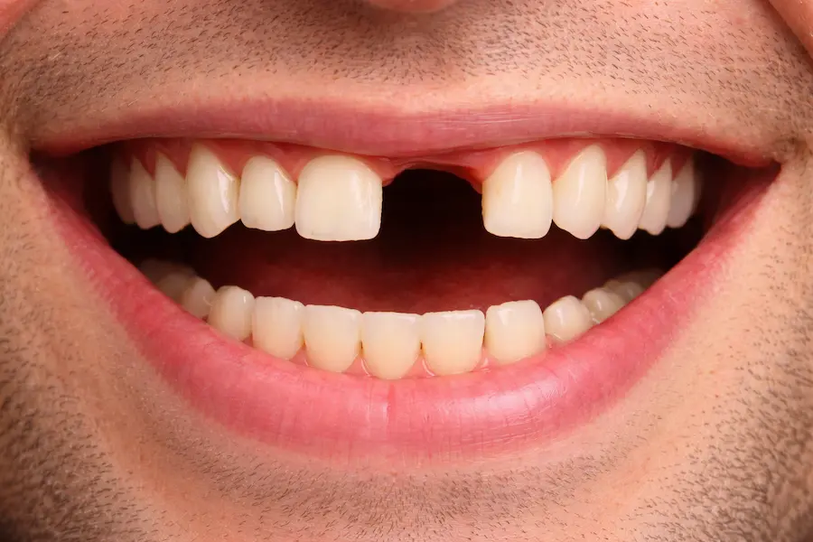 Sorriso com ausência de dente incisivo superior, mostrando espaço vazio na arcada após perda dentária.