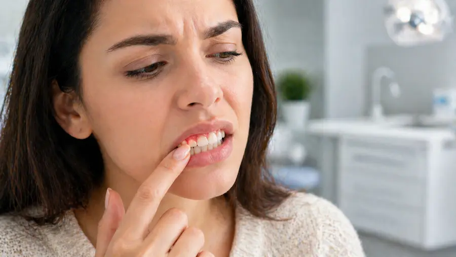 Mulher com dor e inflamação na gengiva, tocando a região com o dedo, indicando possível gengivite.